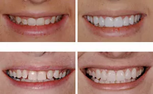 Composite Resin Bonding - Fairfax Cosmetic Dentistry