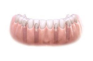 Fairfax dental implants example graphic for tooth implants