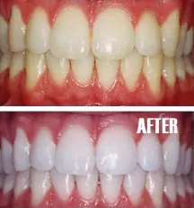 Professional teeth whitening in Fairfax and Chantilly