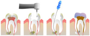 Fairfax root canal near Chantilly graphical demonstration