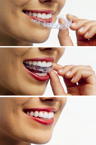 INVISALIGN. Invisible Orthodontics