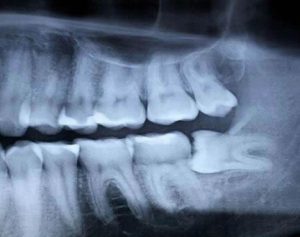 Wisdom Teeth removal x-ray at Centreville Dental Wellness Center near Fairfax and Chantilly