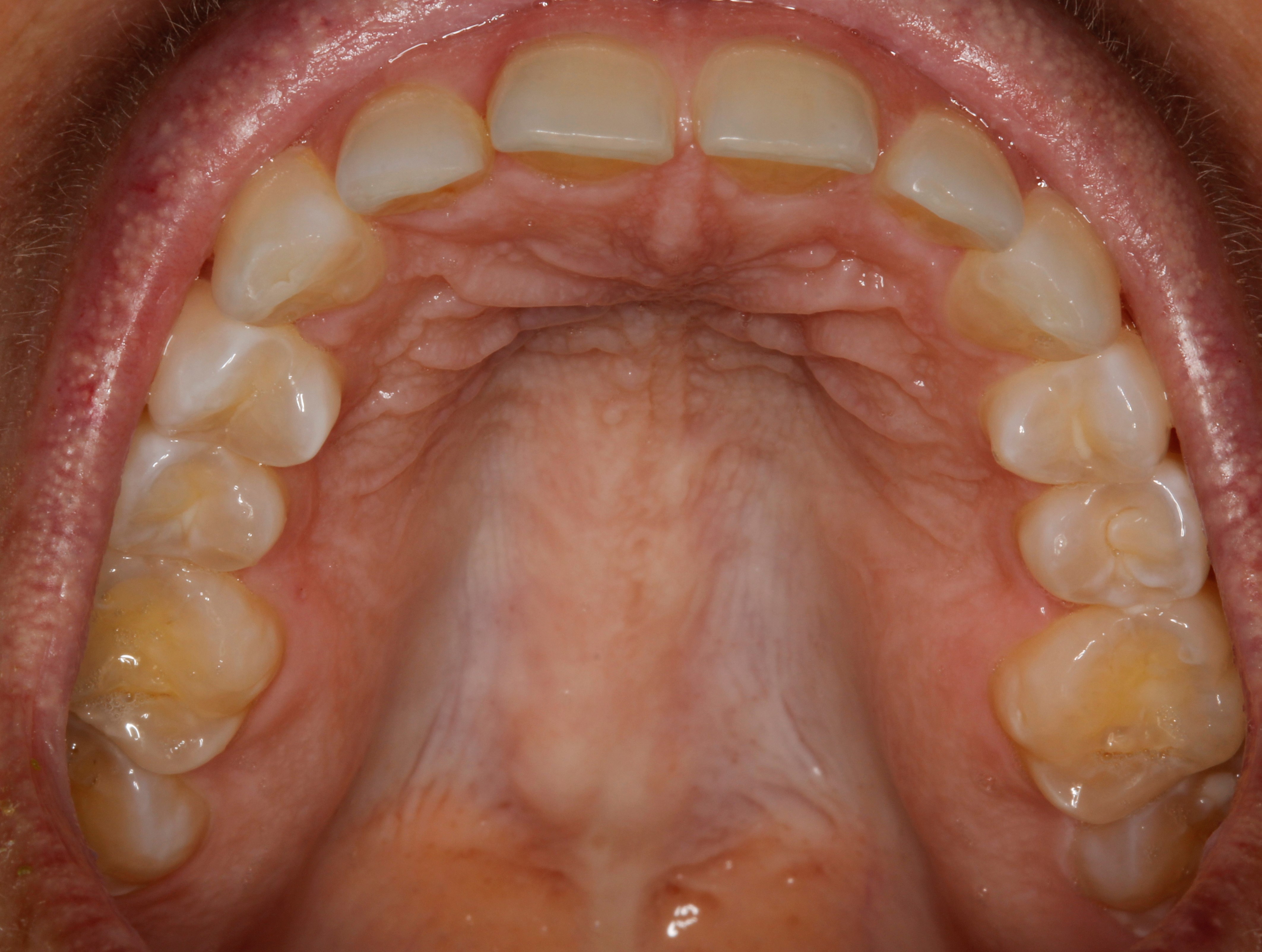 Upper teeth - mouth wide open for biting surface - Centreville Dental