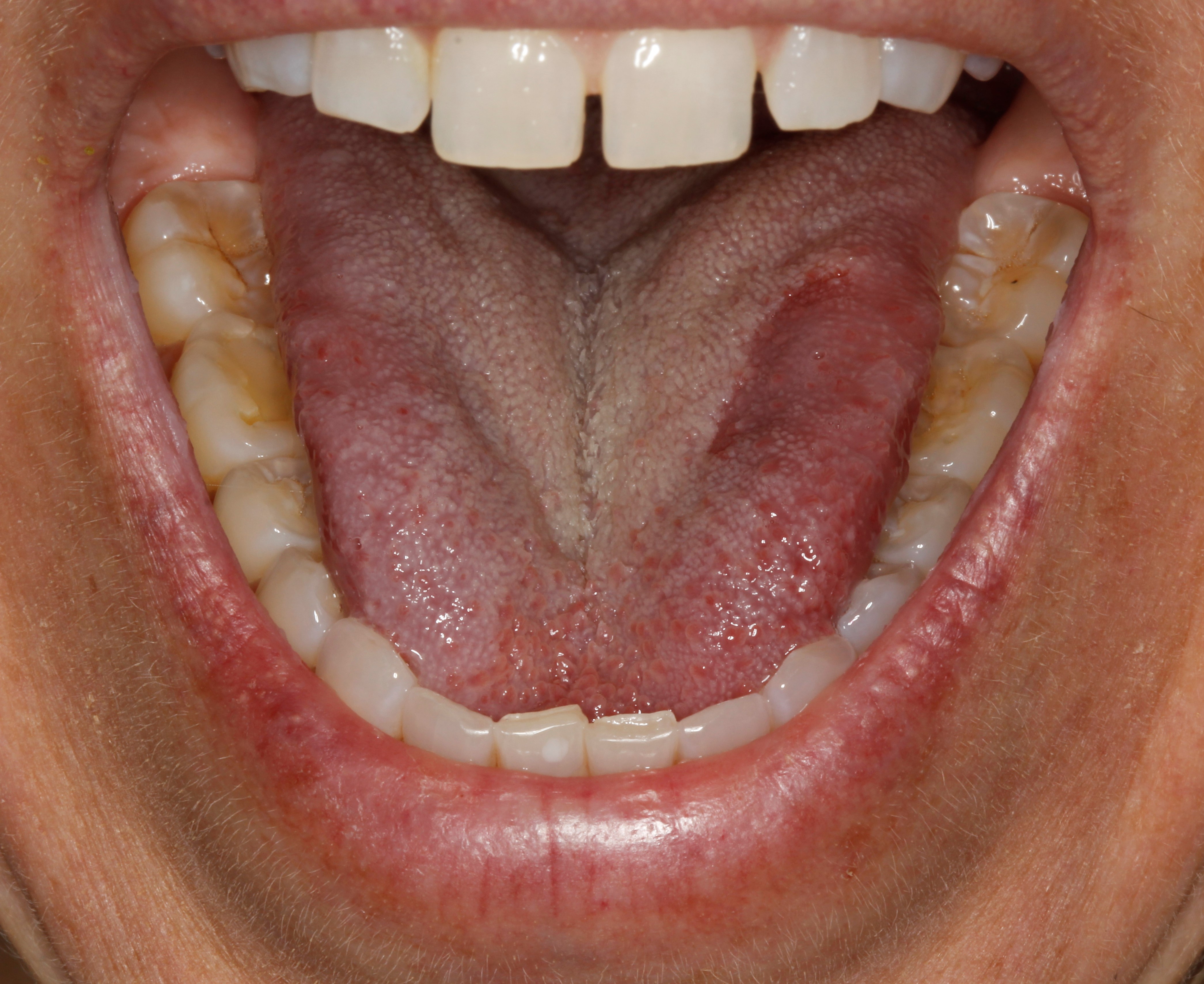 lower teeth -mouth open - Centreville Dental Wellness Center