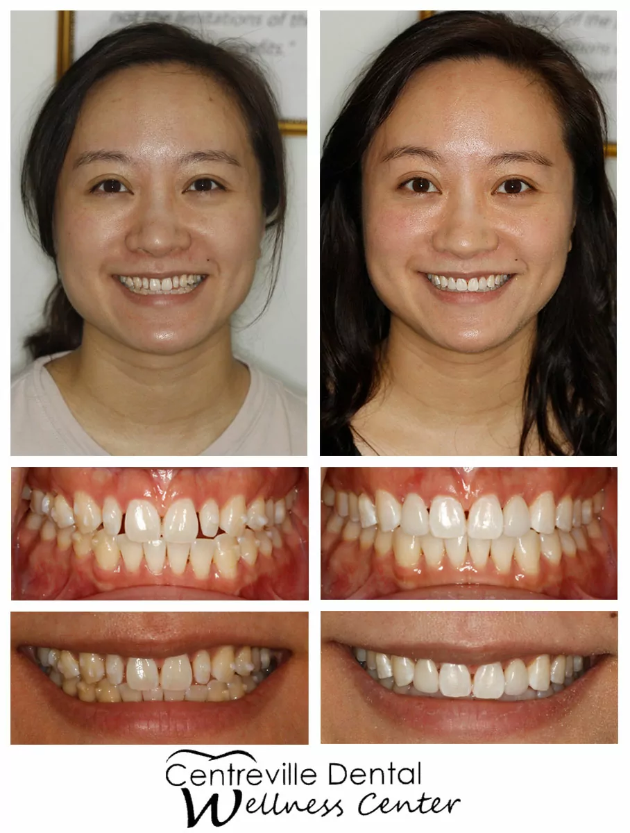 ICON vs. Bonding - Center for Restorative & Cosmetic Dentistry