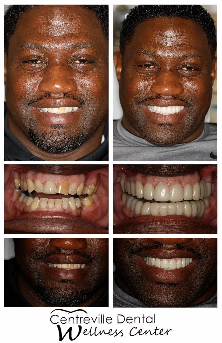 Snap on Smile patient before and after photos at Centreville Dental Wellness Center