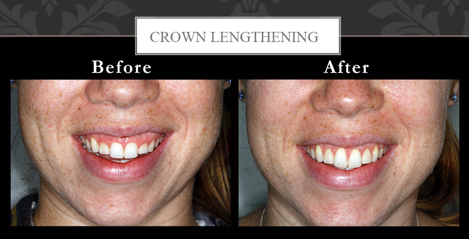 Crown lengthening at Centreville Dental Wellness Center near Manassas and Chantilly before and after photos