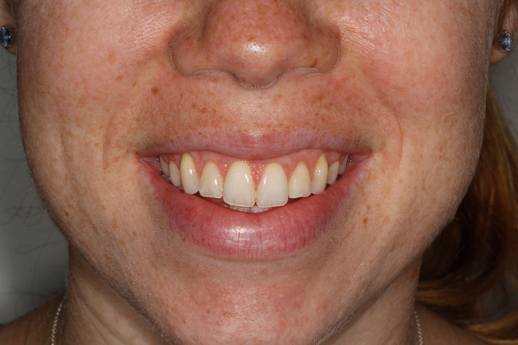 After image