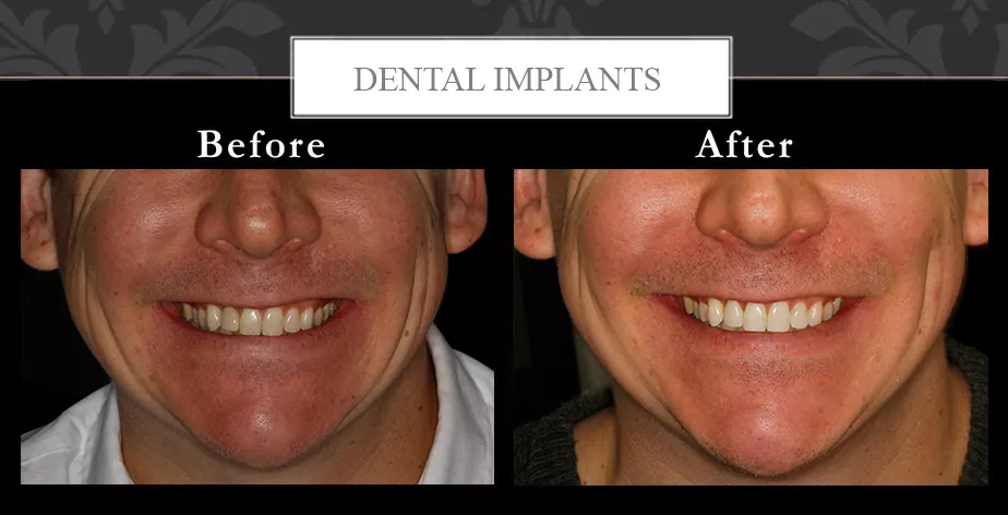 Dental implants at Centreville Dental Wellness Center near Manassas and Chantilly before and after photos