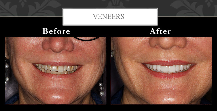 Dental veneers at Centreville Dental Wellness Center near Manassas and Chantilly before and after photos