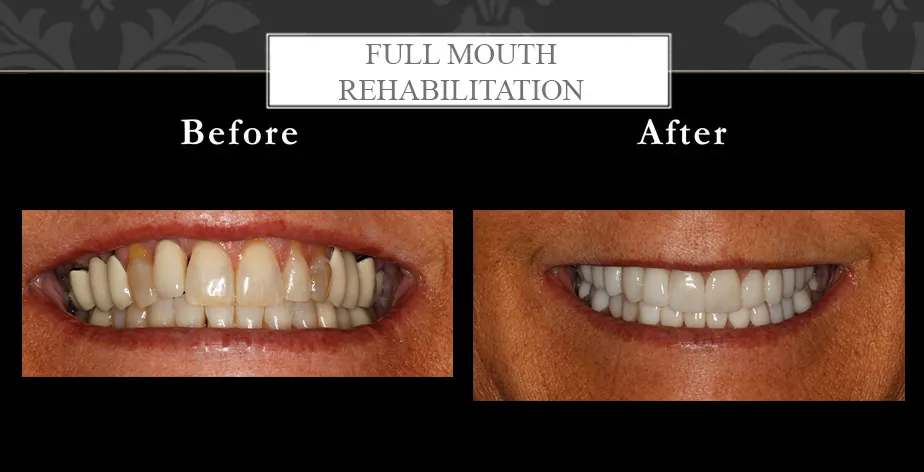full mouth rehabilitation at Centreville Dental Wellness Center near Manassas and Chantilly before and after photos