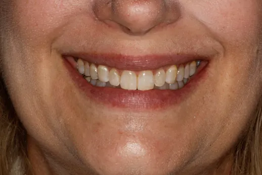 After image