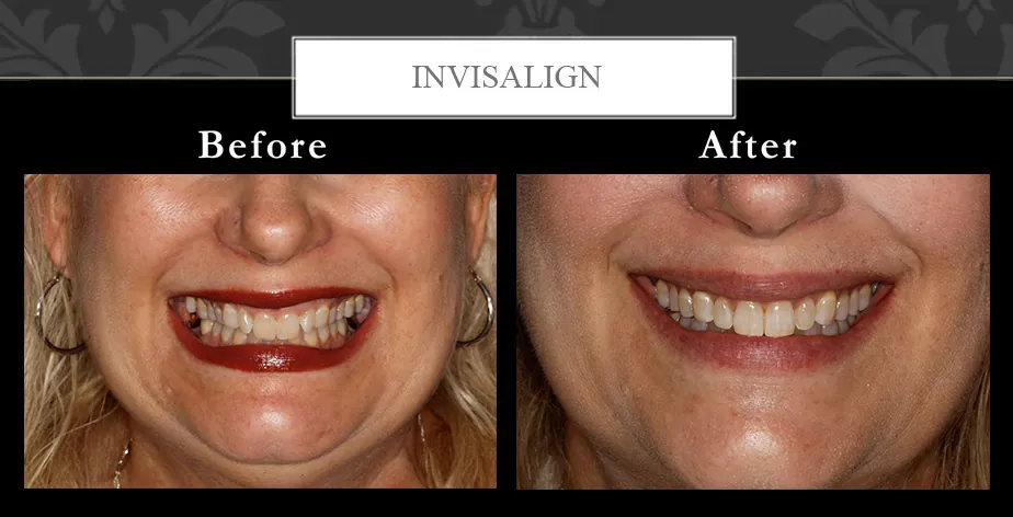 Clear Braces orthodontics at Centreville Dental Wellness Center near Manassas and Chantilly before and after photos