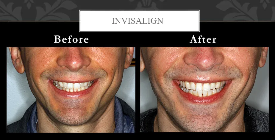 Invisalign at Centreville Dental Wellness Center near Manassas and Chantilly before and after photos