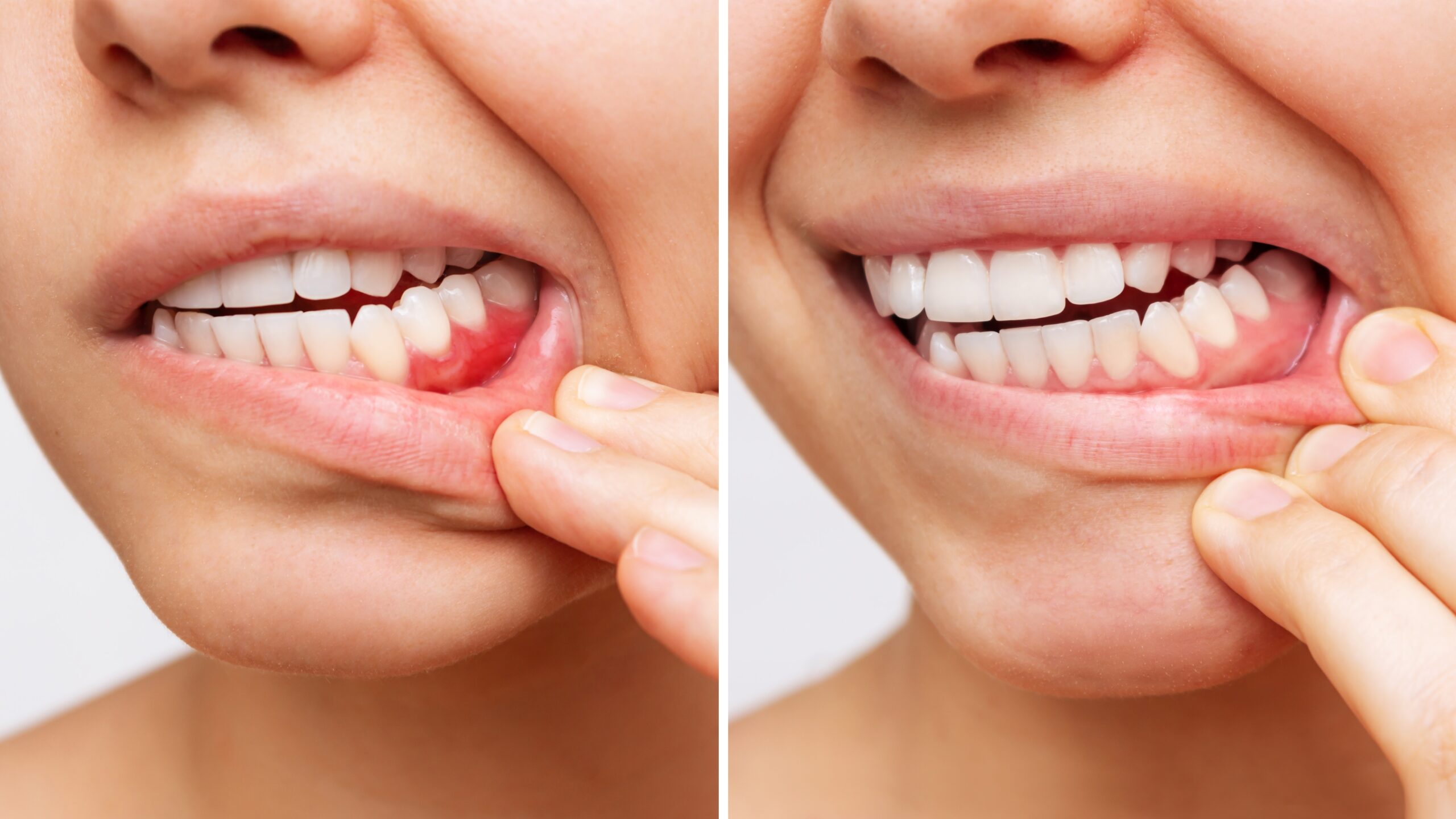side by side showing the progression of gum disease